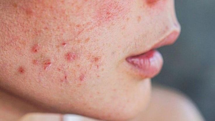 Kích Ứng Hay Đẩy Mụn? Hiểu Đúng Để 