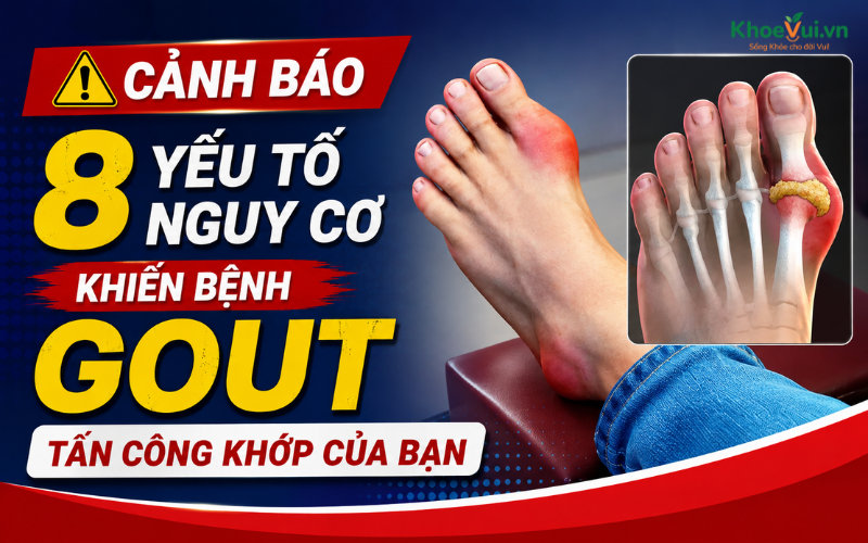 Cảnh báo 8 yếu tố nguy cơ khiến bệnh Gout tấn công khớp của bạn