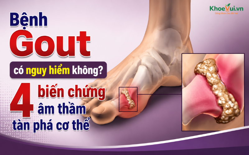 Bệnh Gout có nguy hiểm không? 4 biến chứng âm thầm tàn phá cơ thể