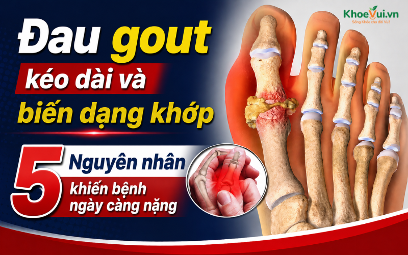 Đau Gout kéo dài và biến dạng khớp: 5 nguyên nhân khiến bệnh ngày càng nặng