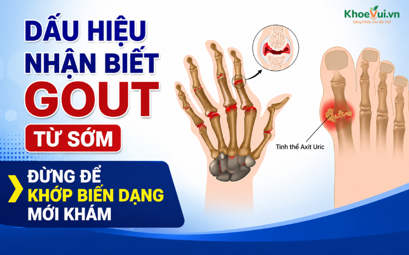 Dấu hiệu nhận biết Gout từ sớm: Đừng để khớp biến dạng mới khám