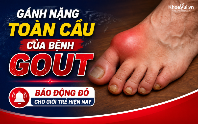 Gánh nặng toàn cầu của bệnh Gout: Báo động đỏ cho giới trẻ hiện nay