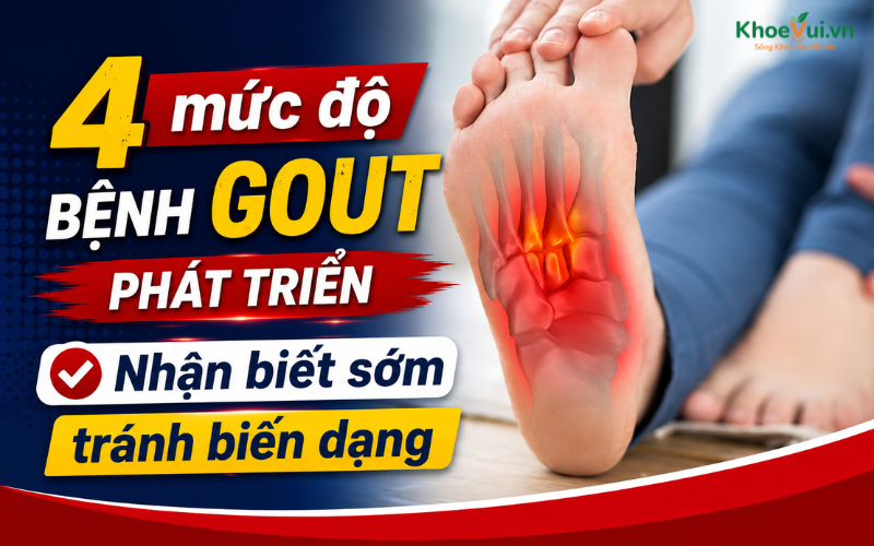 4 mức độ bệnh Gout phát triển: Nhận biết sớm tránh biến dạng