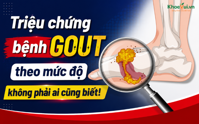 Triệu chứng bệnh Gout theo mức độ không phải ai cũng biết!
