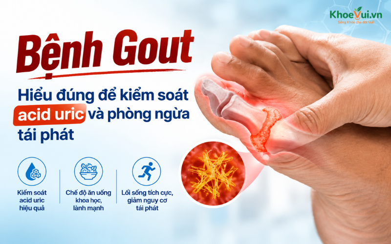 Bệnh Gout: Hiểu đúng để kiểm soát acid uric và phòng ngừa tái phát
