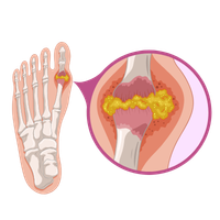Gout