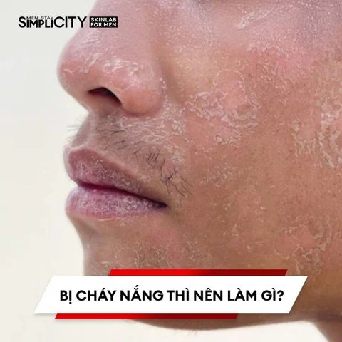 Bị cháy nắng thì nên làm gì?