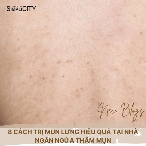 8 cách trị mụn lưng hiệu quả tại nhà ngăn ngừa thâm mụn