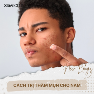 Bật mí cách trị thâm mụn cho nam giới hiệu quả nhất