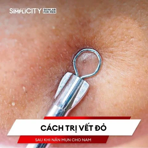 Cách trị vết đỏ sau khi nặn mụn cho nam