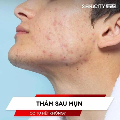 Thâm sau mụn có tự hết không? Giải đáp ngay