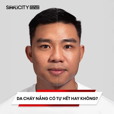 Da cháy nắng có tự hết hay không?