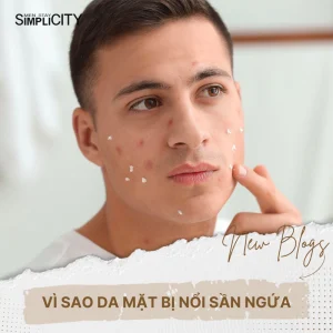 6 cách hạn chế tình trạng da mặt bị dị ứng nổi sần ngứa