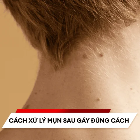 Cách xử lý mụn sau gáy đúng cách cho anh em