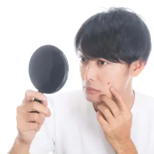 Nam giới bị mụn ở má: 5 nguyên nhân và cách ngăn ngừa