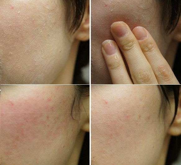 Sữa Rửa Mặt Isis Pharma Giảm Nhờn Và Ngăn Ngừa Mụn Teen Derm Gel 150ml