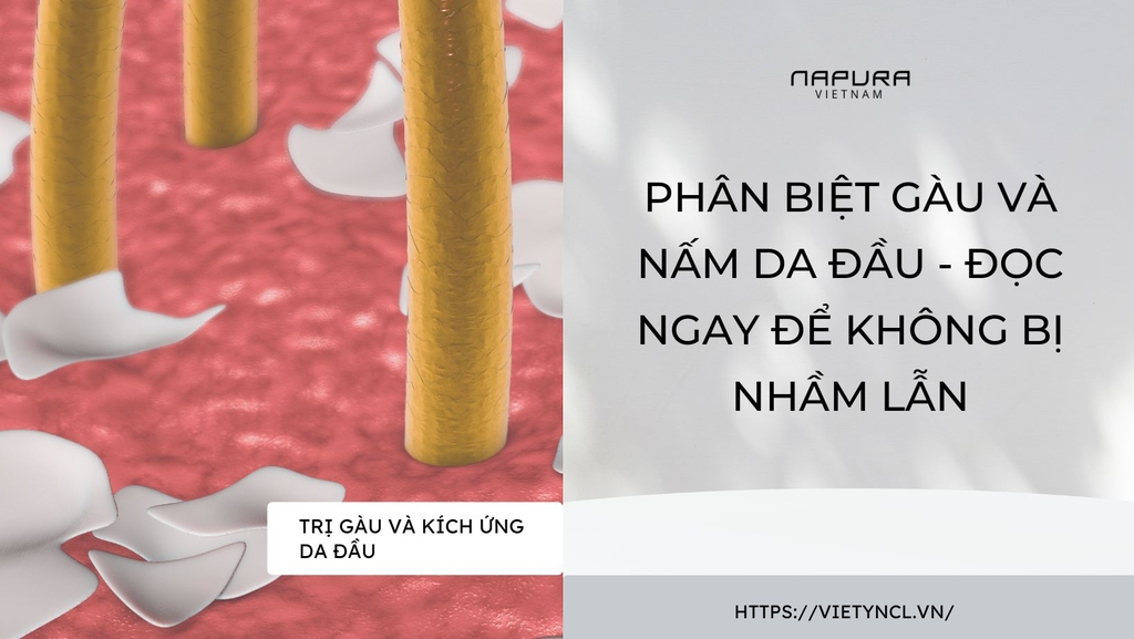 Phân biệt gàu và nấm da đầu - Đọc ngay để không bị nhầm lẫn