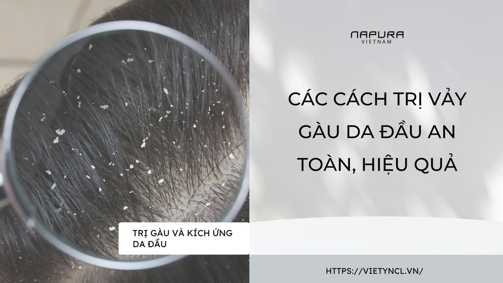 Các cách trị vảy gàu da đầu an toàn, hiệu quả