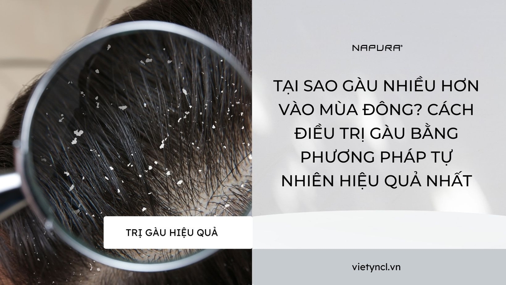 Tại sao gàu nhiều hơn vào mùa đông? Cách điều trị gàu bằng phương pháp tự nhiên hiệu quả nhất