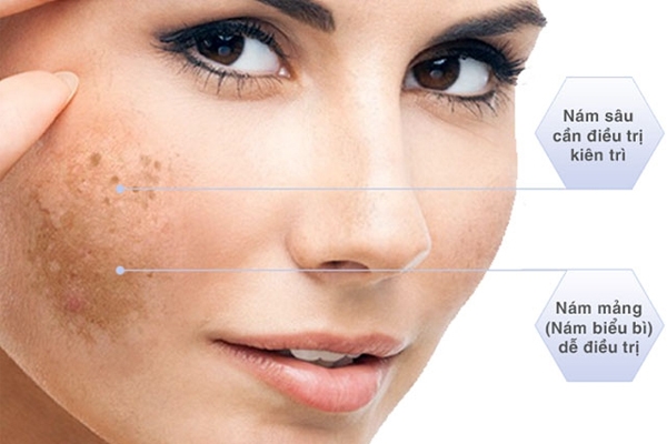 Dùng kem trị nám có tốt không? Kem trị nám nào tốt nhất hiện nay