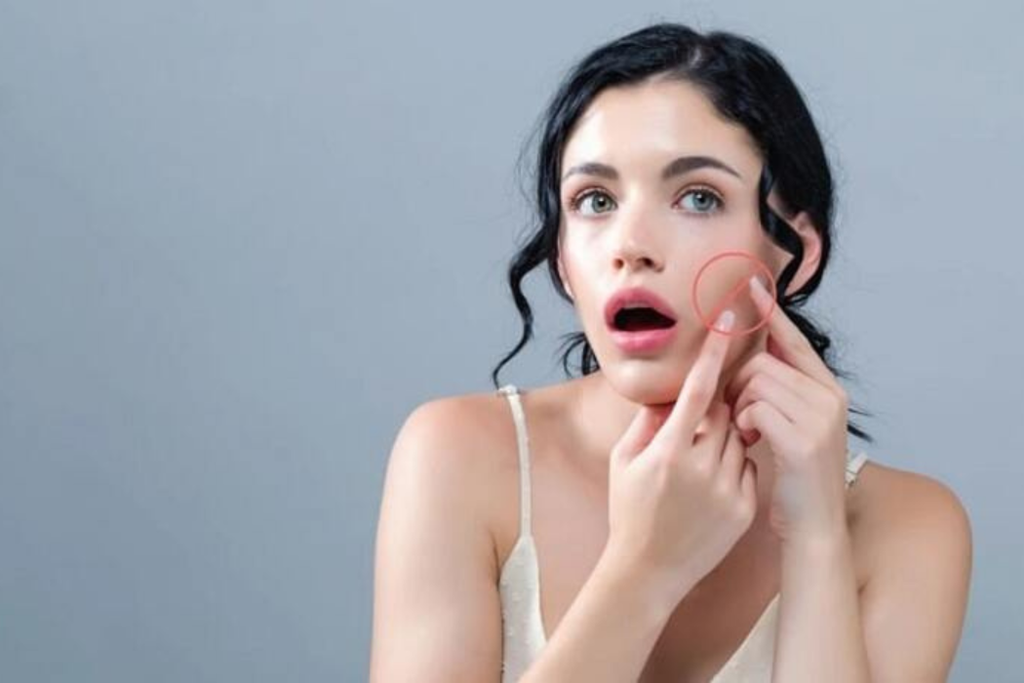 HƯỚNG DẪN CÁCH CHĂM SÓC DA MỤN ĐÚNG CÁCH