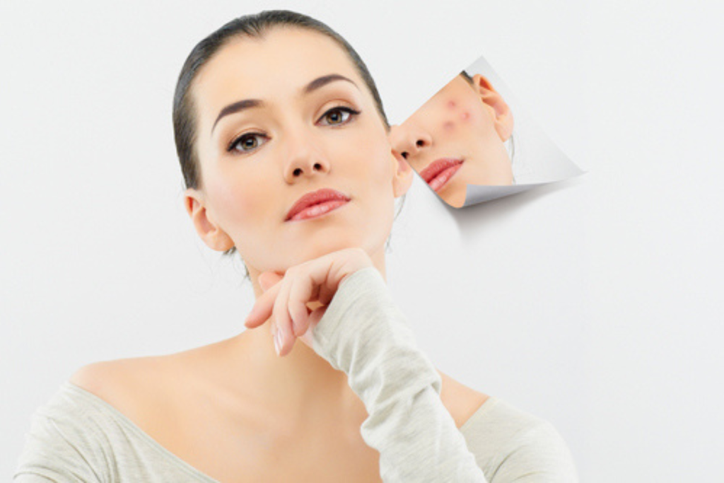 Mụn viêm đỏ không nhân và những điều bạn cần biết
