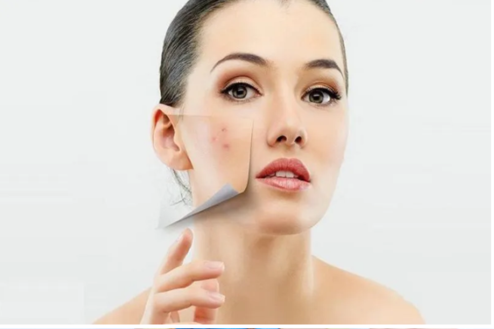 HƯỚNG DẪN CÁCH CHĂM SÓC DA MỤN ĐÚNG CÁCH