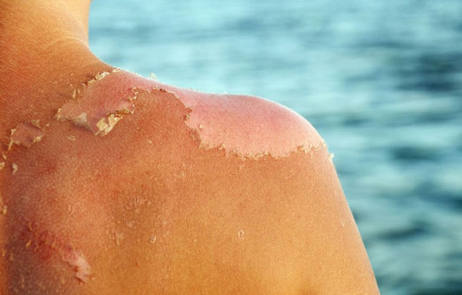 Bác sĩ tại nhà: Làm gì khi bị bỏng nắng do tia UV?