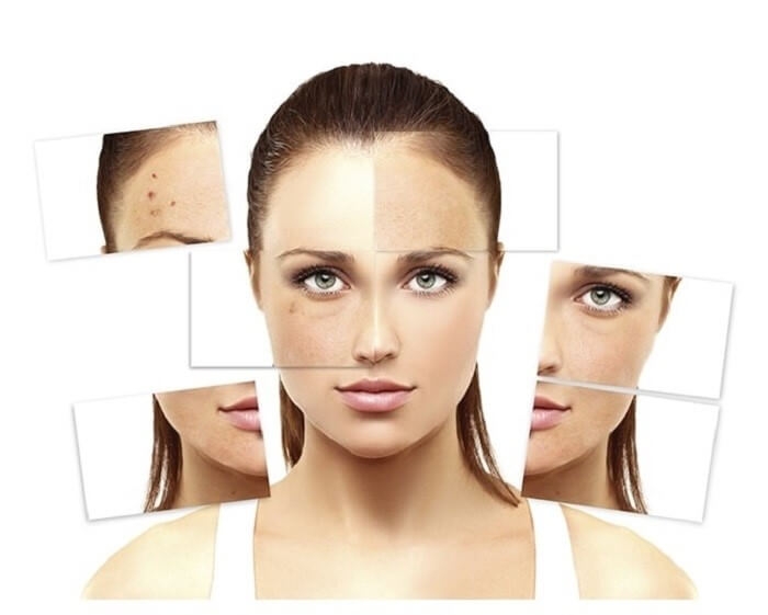 5 cách chăm sóc da mặt bị nám, tàn nhang cực đơn giản