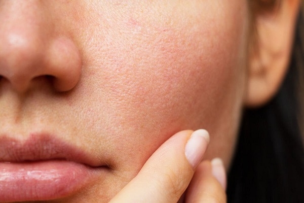 Làm thế nào để chăm sóc làn da khô hiệu quả?