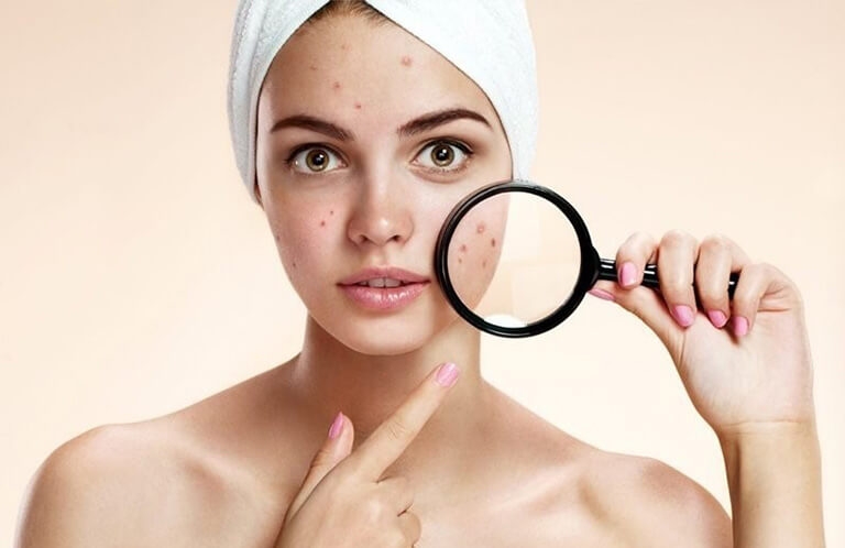 Dùng sữa rửa mặt bị nổi mụn nguyên nhân do đâu?