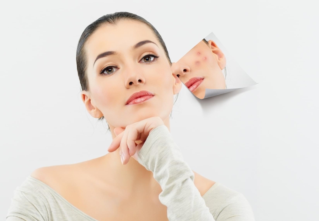 Điều trị mụn ẩn nên dùng AHA hay BHA thì hiệu quả?