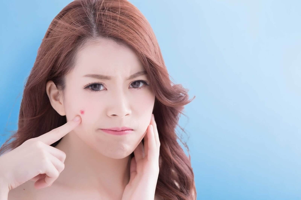 Mách bạn cách hết mụn nhanh nhất bằng nguyên liệu tự nhiên