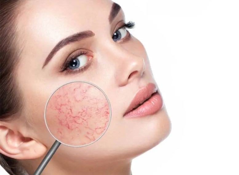 Phục hồi da mặt mỏng hiệu quả ngay tại nhà