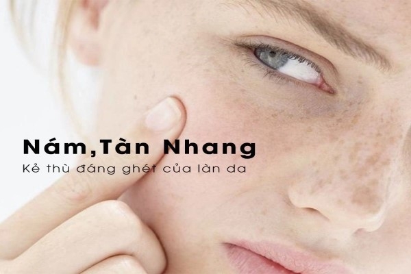 Nám là gì? Tàn nhang là gì? Nguyên nhân gây ra các đốm trên mặt thường gặp