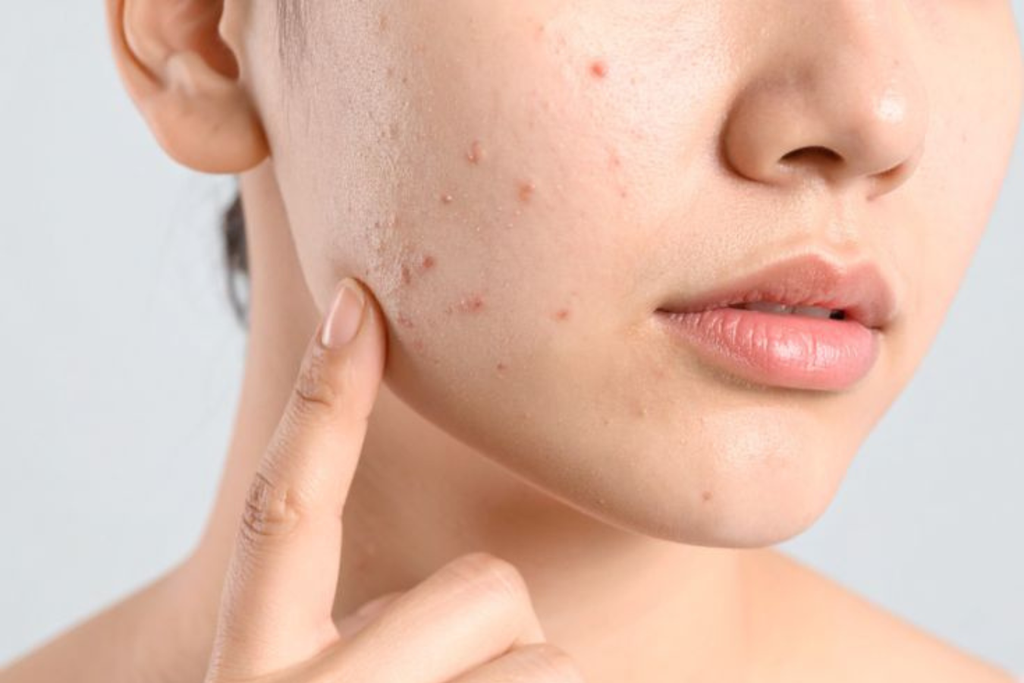 Vì Sao Bạn Bị Mụn Dù Đã Skincare Đủ Bước
