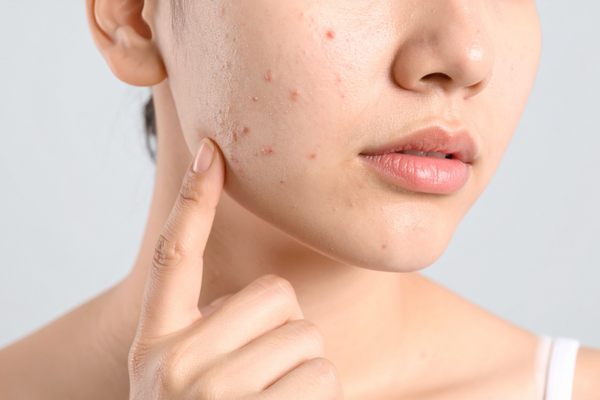 Da Dễ Nổi Mụn Cần Tránh Những Thói Quen Nào?