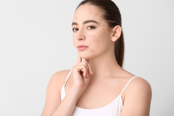 Mụn ẩn và quy tắc chăm da hiệu quả?