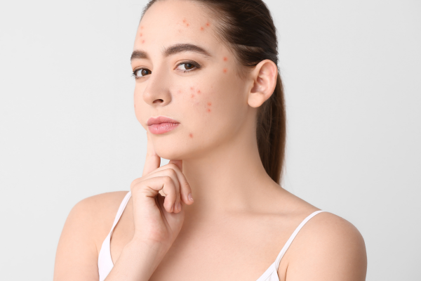 Da Mụn Nội Tiết Khác Gì Mụn Do Mỹ Phẩm? Hiểu Đúng Để Xử Lý Đúng!