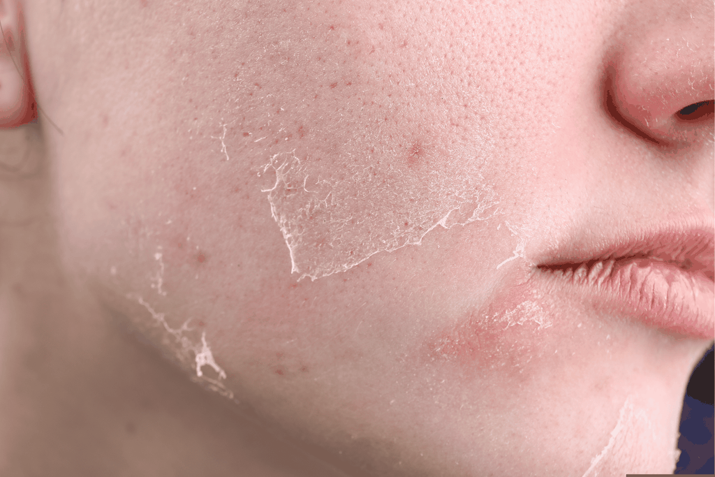 Hướng Dẫn Chăm Sóc Da Khô Thiếu Nước Đúng Cách