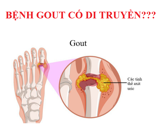 Bệnh gout có di truyền?