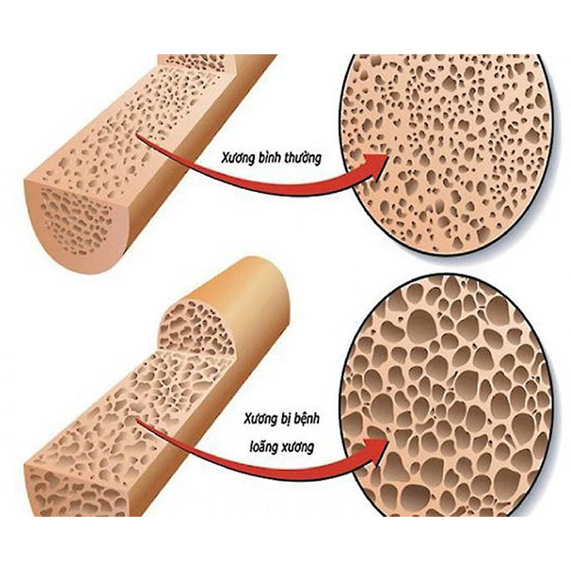 9 Dấu Hiệu Chứng Tỏ Cơ Thể Đang Thiếu Canxi