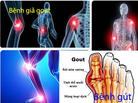 Bệnh giả gút và gút khác nhau thế nào?