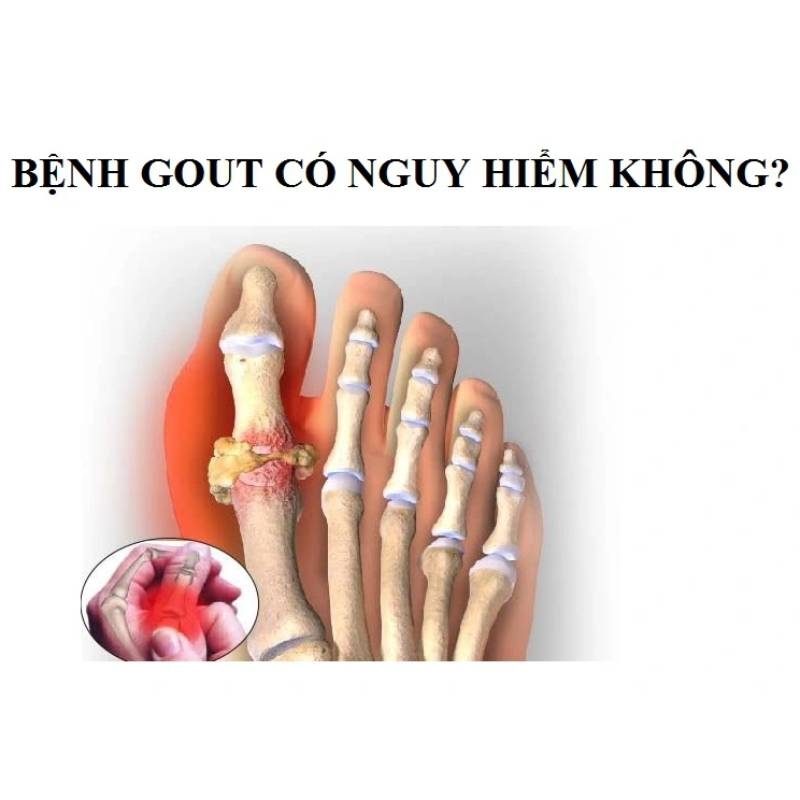 Bệnh gout có nguy hiểm?