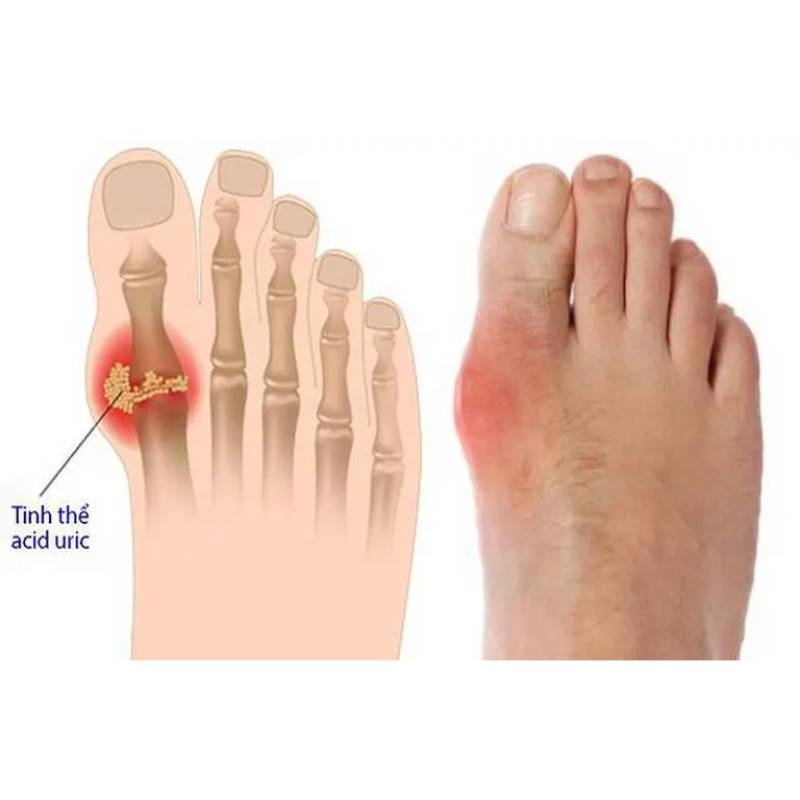 5 biến chứng nguy hiểm của bệnh gout