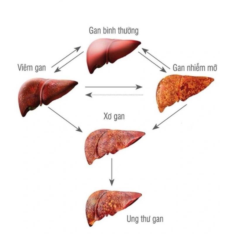 CÁC BỆNH THƯỜNG GẶP Ở GAN