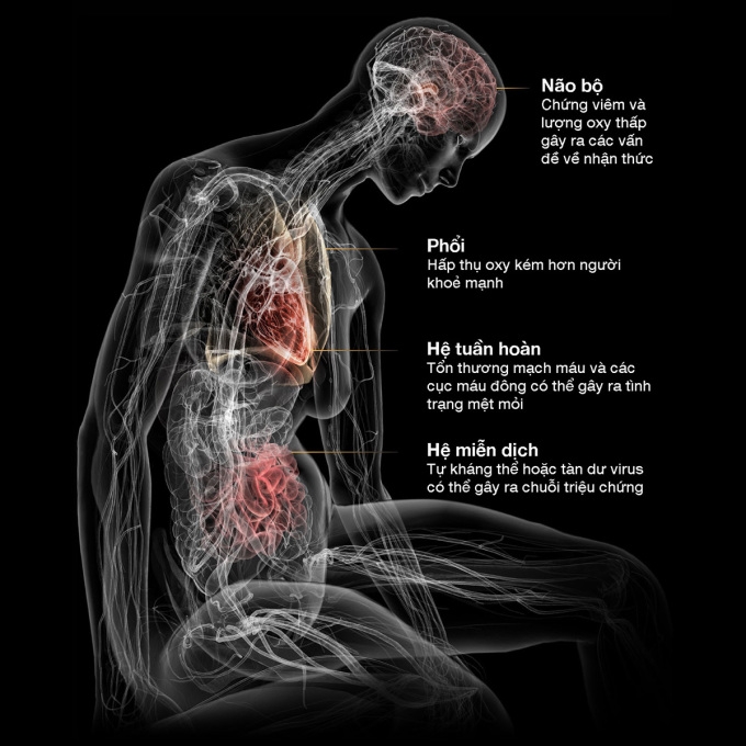 Covid-19 kéo dài tàn phá cơ thể thế nào
