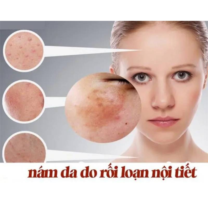 Hiểu đúng nguyên nhân để điều trị nám da hiệu quả