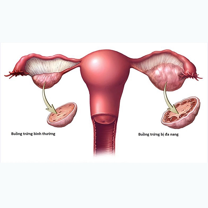 Hội chứng buồng trứng đa nang: Triệu chứng, nguyên nhân và cách điều trị
