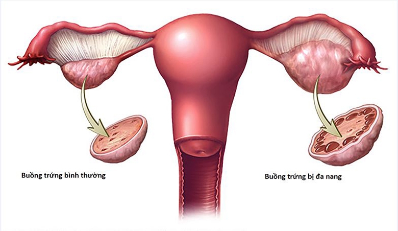 Hội chứng buồng trứng đa nang: Triệu chứng, nguyên nhân và cách điều trị